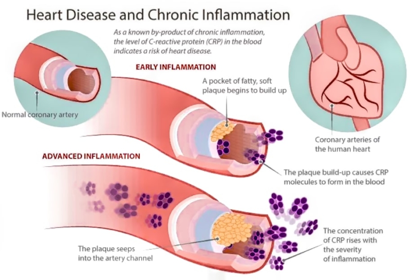 chefv-crp-inflammation-1000p CRP blood test for inflammation